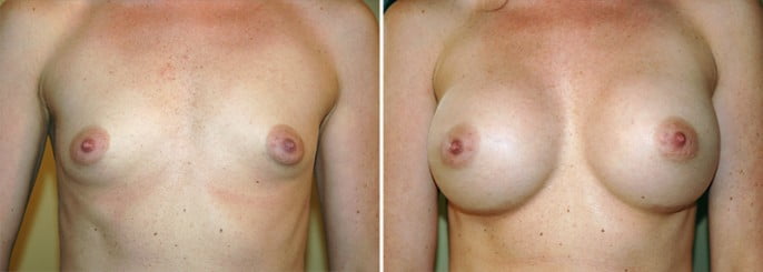 Maryland Breast Augmentation 1 Maryland Breast Augmentation 1