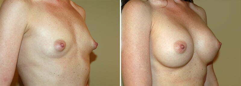 Maryland Breast Augmentation 1