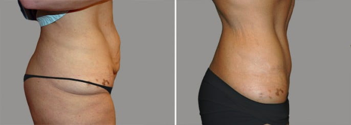 tummy-tuck-01c tummy-tuck-01c