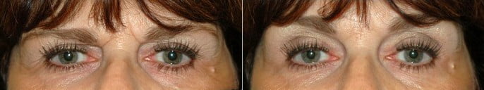 Before and after non-surgical injectable brow lift