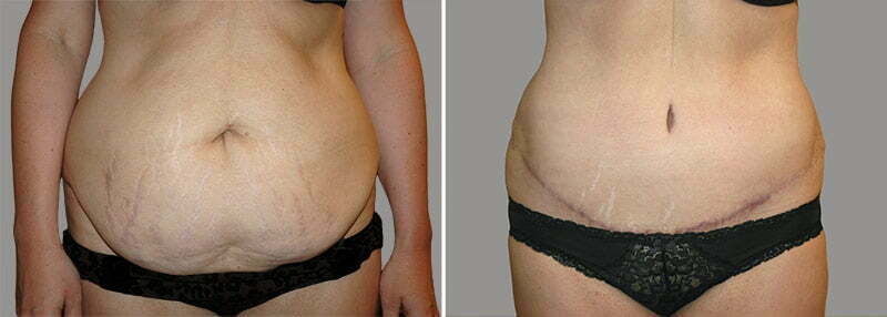 Tummy Tuck Patient 2