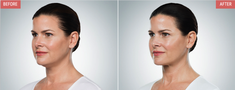 Before and after Kybella