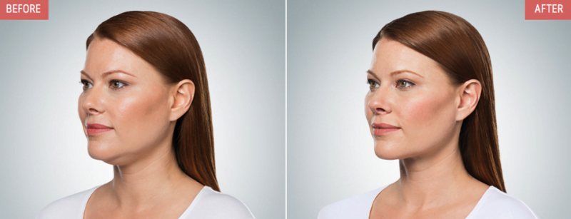 Before and after Kybella