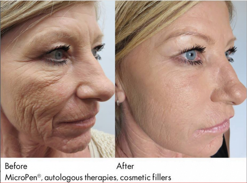 Before and after microneedling, facial fat injections, and dermal fillers
