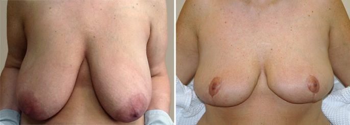 breast-lift-13399a-garazo breast-lift-13399a-garazo