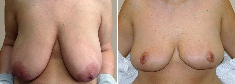 breast-lift-13399a-garazo