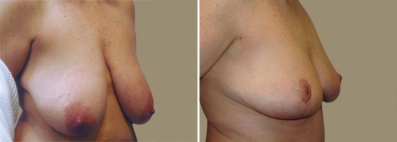 breast-lift-13399b-garazo