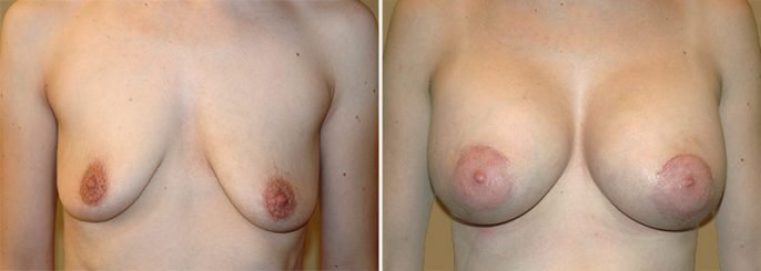 breast-lift-with-augmentation-13369a-garazo breast-lift-with-augmentation-13369a-garazo