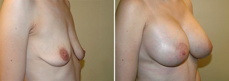 breast-lift-with-augmentation-13369b-garazo
