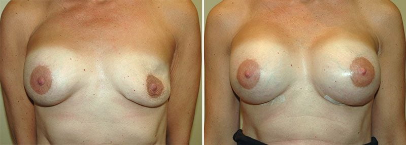 revision-breast-augmentation-13356a-garazo