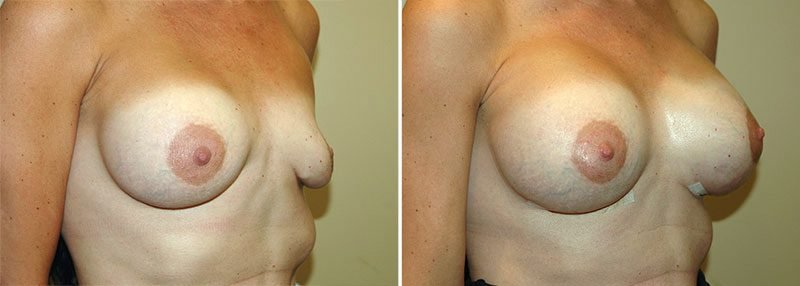 revision-breast-augmentation-13356b-garazo