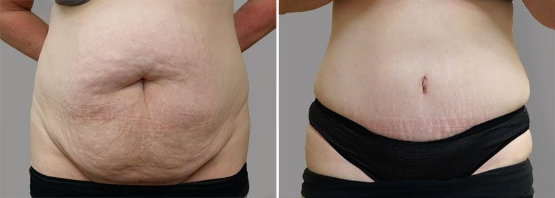 Tummy Tuck Patient 3