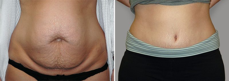 Tummy Tuck Patient 4