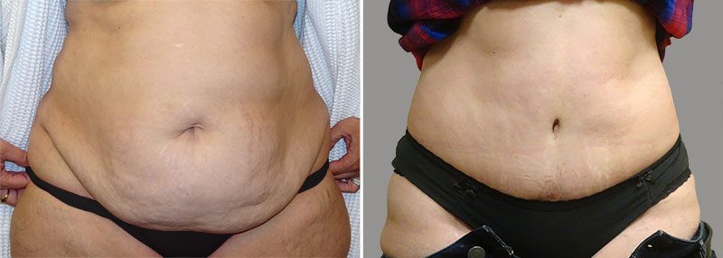 Tummy Tuck Patient 5