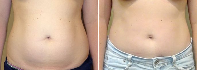 liposuction-abdomen-14345a-garazo liposuction-abdomen-14345a-garazo
