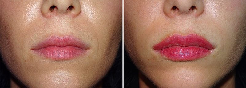 Before and after lip enhancement with injectable lip filler