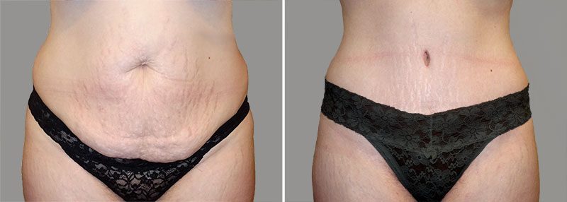 Tummy Tuck Patient 6