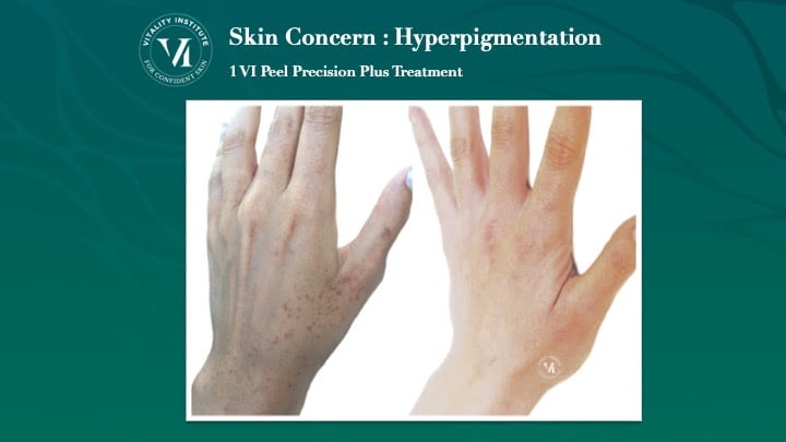 Skin Concern Hyperpigmentation VI Peel Before and After hand treatment