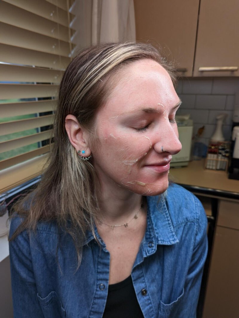 Real patient during a chemical peel treatment