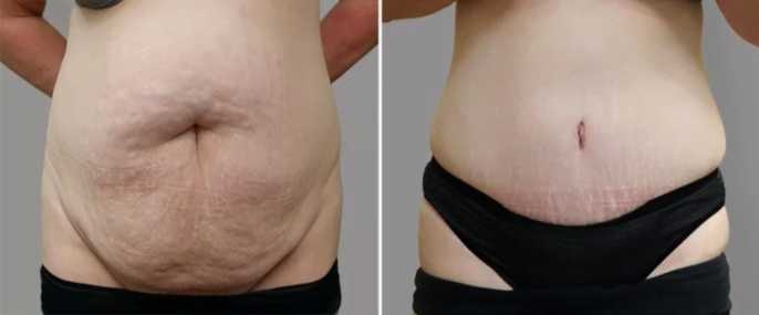 Before and after tummy tuck surgery with Dr. Henry Garazo 