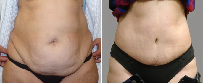 Tummy tuck procedure with great belly button results