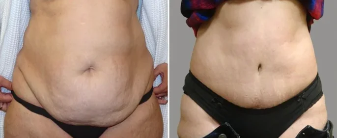 Post-Partum Belly Repair (Tummy Tucks) - Explore Plastic Surgery