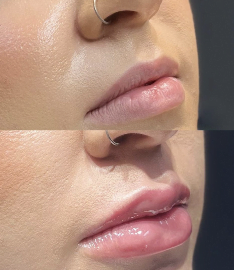 woman with fuller lips after Volbella lip injection treatment at Plastic Surgery Services of Hagerstown, MD