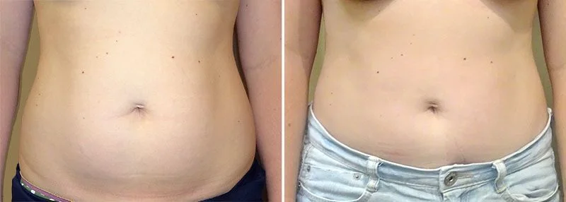 Liposuction patient results with Maryland plastic surgeon Dr. Henry Garazo