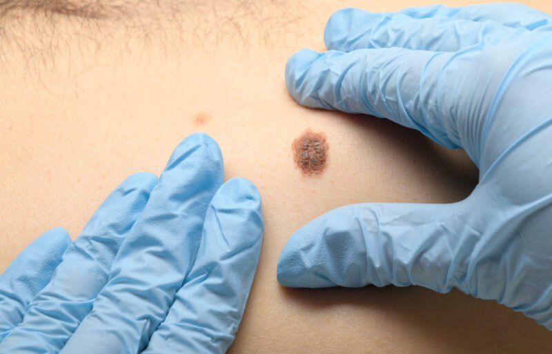 Dermatologist examining abnormal mole on a man's back
