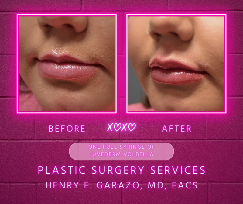 Before and after Juvederm Volbella by plastic surgeon Dr. Henry Garazo