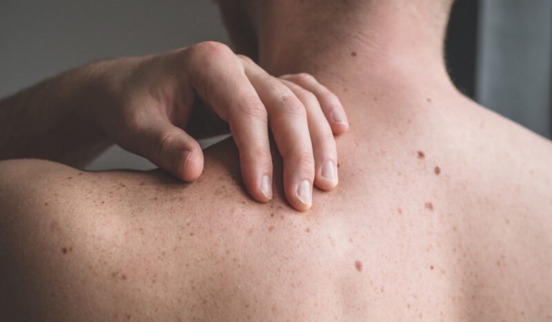 Man touching melasma on back wondering if it is skin cancer