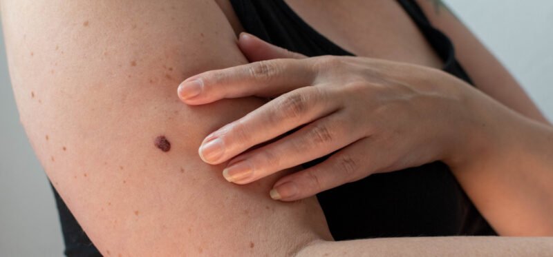 Woman with abnormal mole on her arm