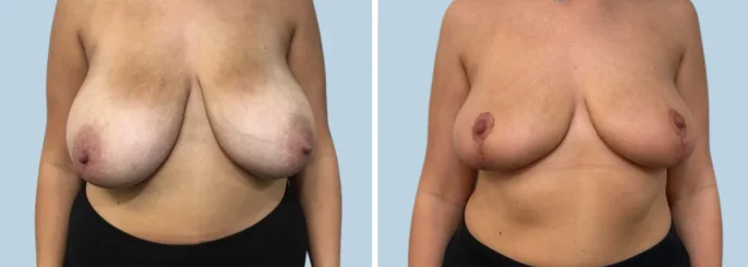 Before & After photo of the patient’s Breast Reduction Pat 1
