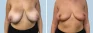 See more Before & After photos – Breast Reduction Pat 1