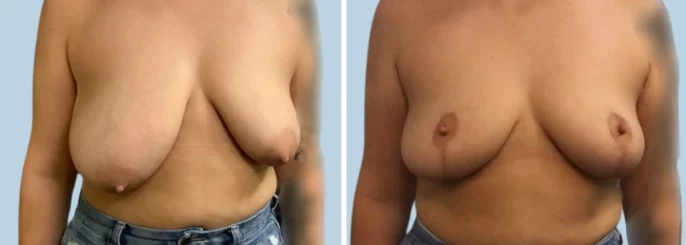 Before & After photo of the patient’s Breast Reduction Pat 4