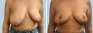 See more Before & After photos – Breast Reduction Pat 4