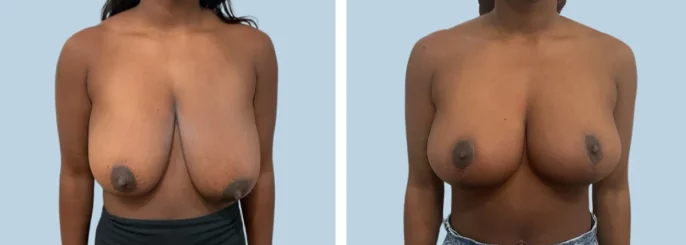 Before & After photo of the patient’s Breast Reduction Pat 2