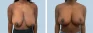 See more Before & After photos – Breast Reduction Pat 2