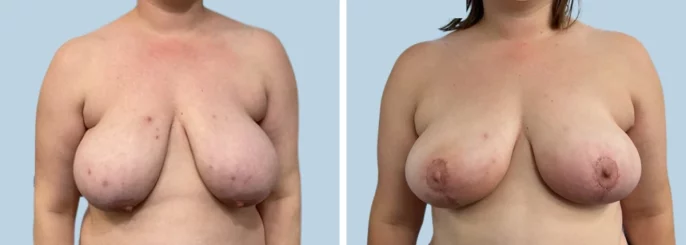 Before & After photo of the patient’s Breast Reduction Pat 3