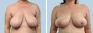 See more Before & After photos – Breast Reduction Pat 3