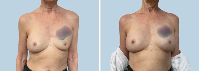 Before & After photo of the patient’s Breast Augmentation 80