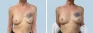 See more Before & After photos – Breast Augmentation 80