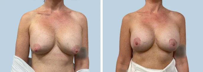 Before & After photo of the patient’s Breast Augmentation 81