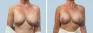 See more Before & After photos – Breast Augmentation 81