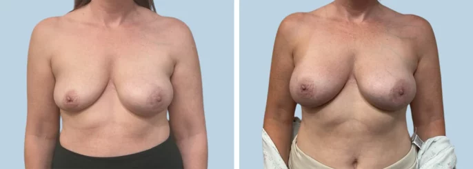 Before & After photo of the patient’s Breast Augmentation 82