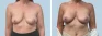 See more Before & After photos – Breast Augmentation 82