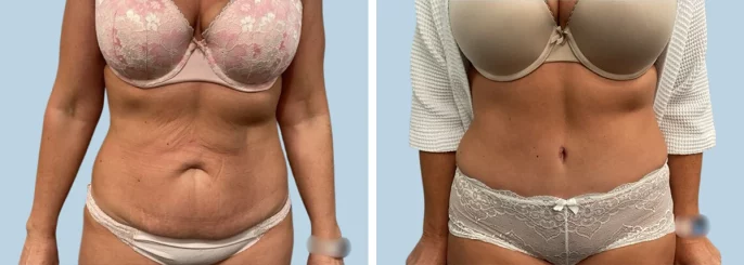 Before & After photo of the patient’s Tummy Tuck Patient 11