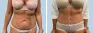 See more Before & After photos – Tummy Tuck Patient 11